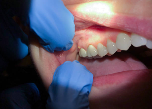 Best Emergency Dental Care for Broken or Chipped Teeth in Dassel, MN